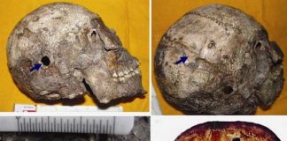 Skull with brain surgery discovered in India