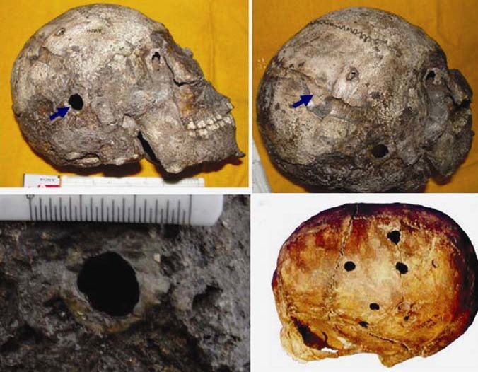 Skull with brain surgery discovered in India